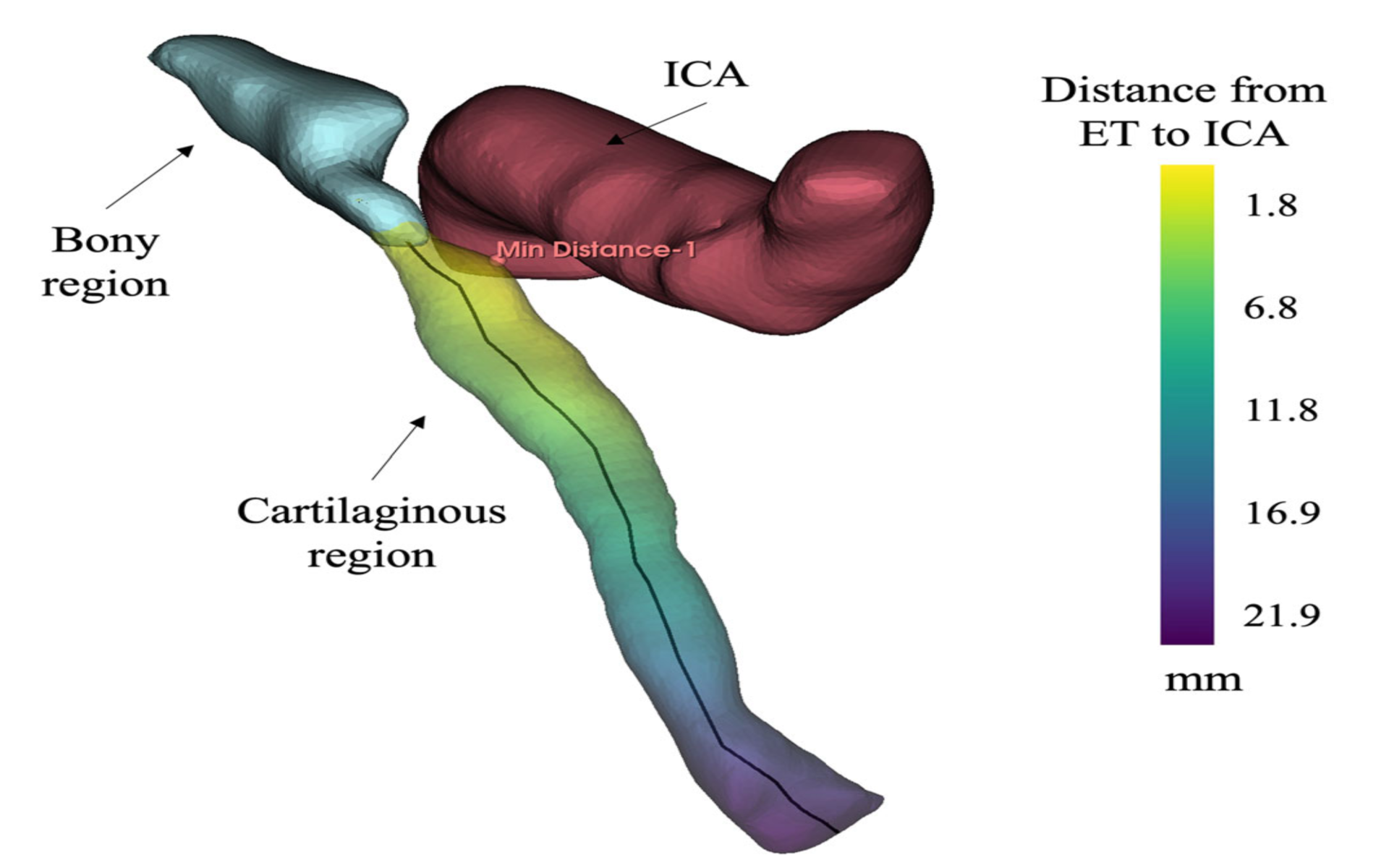 3D Mesh of ET and ICA